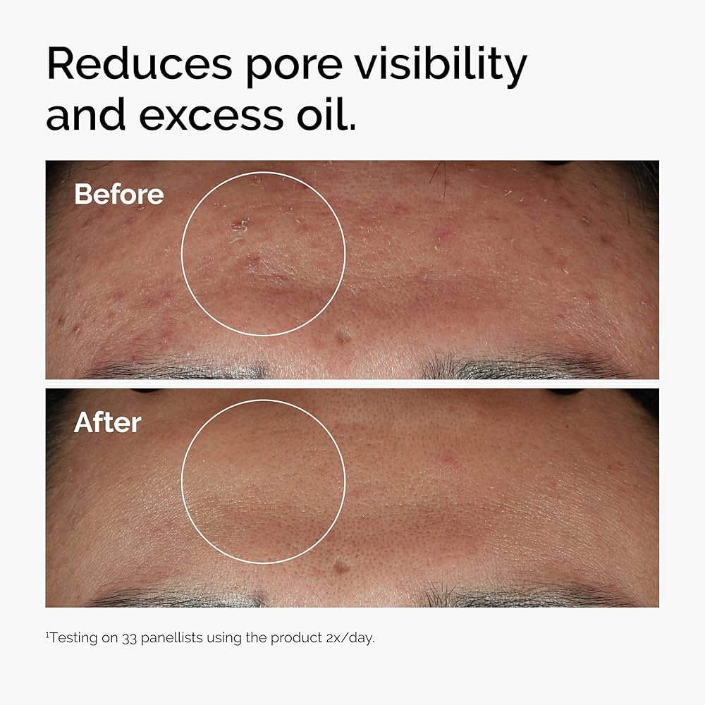 The Ordinary Niacinamide 10% + Zinc 1% - 30 ml